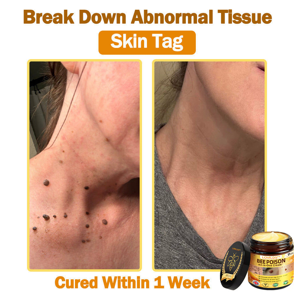 [𝐎𝐟𝐟𝐢𝐜𝐢𝐚𝐥 𝐁𝐫𝐚𝐧𝐝 𝐒𝐭𝐨𝐫𝐞] 🐝 LOVILDS™ 𝐁𝐞𝐞 𝐕𝐞𝐧𝐨𝐦 𝐀𝐥𝐥-𝐢𝐧-𝐎𝐧𝐞 𝐂𝐫𝐞𝐚𝐦 (👩‍⚕️ 𝐁𝐫𝐢𝐭𝐢𝐬𝐡 𝐀𝐜𝐚𝐝𝐞𝐦𝐲 𝐨𝐟 𝐃𝐞𝐫𝐦𝐚𝐭𝐨𝐥𝐨𝐠𝐲 𝟐𝟎𝟐𝟓 𝐒𝐩𝐞𝐜𝐢𝐚𝐥𝐥𝐲 𝐑𝐞𝐜𝐨𝐦𝐦𝐞𝐧𝐝𝐞𝐝 𝐏𝐫𝐨𝐝𝐮𝐜𝐭)