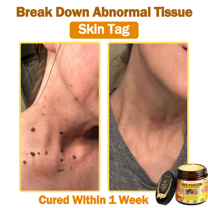 [𝐎𝐟𝐟𝐢𝐜𝐢𝐚𝐥 𝐁𝐫𝐚𝐧𝐝 𝐒𝐭𝐨𝐫𝐞] 🐝 LOVILDS™ 𝐁𝐞𝐞 𝐕𝐞𝐧𝐨𝐦 𝐀𝐥𝐥-𝐢𝐧-𝐎𝐧𝐞 𝐂𝐫𝐞𝐚𝐦 (👩‍⚕️ 𝐁𝐫𝐢𝐭𝐢𝐬𝐡 𝐀𝐜𝐚𝐝𝐞𝐦𝐲 𝐨𝐟 𝐃𝐞𝐫𝐦𝐚𝐭𝐨𝐥𝐨𝐠𝐲 𝟐𝟎𝟐𝟓 𝐒𝐩𝐞𝐜𝐢𝐚𝐥𝐥𝐲 𝐑𝐞𝐜𝐨𝐦𝐦𝐞𝐧𝐝𝐞𝐝 𝐏𝐫𝐨𝐝𝐮𝐜𝐭)