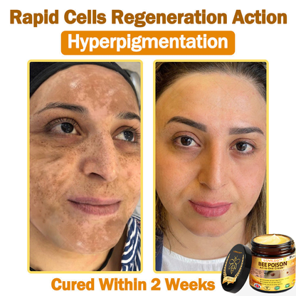 [𝐎𝐟𝐟𝐢𝐜𝐢𝐚𝐥 𝐁𝐫𝐚𝐧𝐝 𝐒𝐭𝐨𝐫𝐞] 🐝 LOVILDS™ 𝐁𝐞𝐞 𝐕𝐞𝐧𝐨𝐦 𝐀𝐥𝐥-𝐢𝐧-𝐎𝐧𝐞 𝐂𝐫𝐞𝐚𝐦 (👩‍⚕️ 𝐁𝐫𝐢𝐭𝐢𝐬𝐡 𝐀𝐜𝐚𝐝𝐞𝐦𝐲 𝐨𝐟 𝐃𝐞𝐫𝐦𝐚𝐭𝐨𝐥𝐨𝐠𝐲 𝟐𝟎𝟐𝟓 𝐒𝐩𝐞𝐜𝐢𝐚𝐥𝐥𝐲 𝐑𝐞𝐜𝐨𝐦𝐦𝐞𝐧𝐝𝐞𝐝 𝐏𝐫𝐨𝐝𝐮𝐜𝐭)