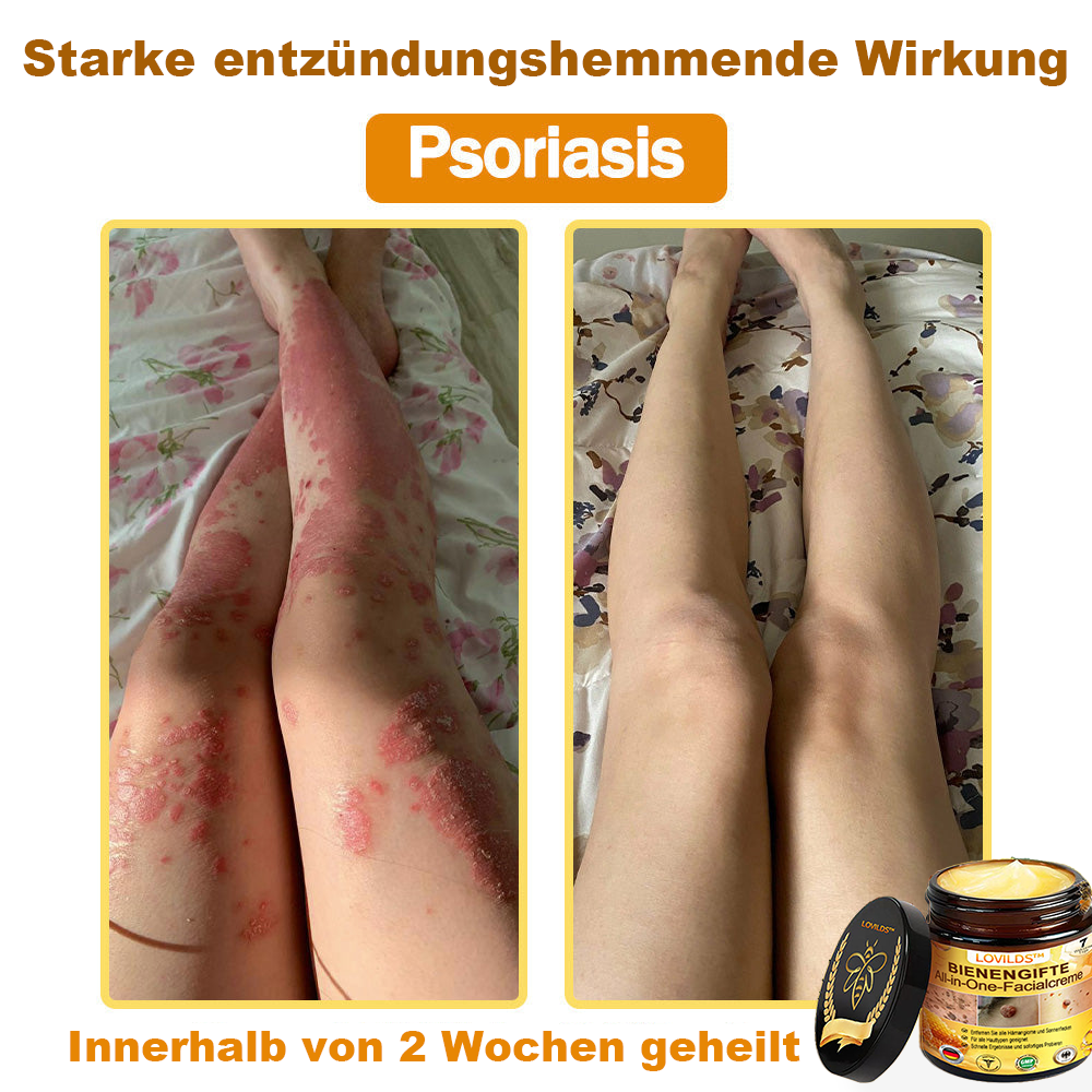 [offizieller Markenshop] 🐝 LOVILDS™ Bienengift-All-Action-Creme (👩‍⚕️ Deutsche Dermatologische Gesellschaft e.V. 𝟐𝟎𝟐𝟓Besonders empfehlenswerte Produkte)💟