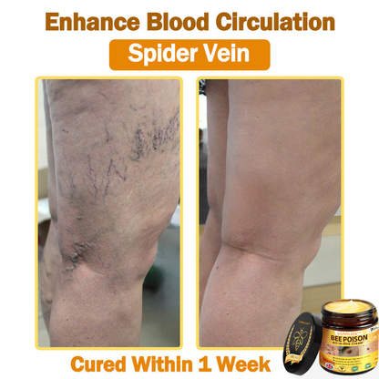 [𝐎𝐟𝐟𝐢𝐜𝐢𝐚𝐥 𝐁𝐫𝐚𝐧𝐝 𝐒𝐭𝐨𝐫𝐞] 🐝 LOVILDS™ 𝐁𝐞𝐞 𝐕𝐞𝐧𝐨𝐦 𝐀𝐥𝐥-𝐢𝐧-𝐎𝐧𝐞 𝐂𝐫𝐞𝐚𝐦 (👩‍⚕️ 𝐁𝐫𝐢𝐭𝐢𝐬𝐡 𝐀𝐜𝐚𝐝𝐞𝐦𝐲 𝐨𝐟 𝐃𝐞𝐫𝐦𝐚𝐭𝐨𝐥𝐨𝐠𝐲 𝟐𝟎𝟐𝟓 𝐒𝐩𝐞𝐜𝐢𝐚𝐥𝐥𝐲 𝐑𝐞𝐜𝐨𝐦𝐦𝐞𝐧𝐝𝐞𝐝 𝐏𝐫𝐨𝐝𝐮𝐜𝐭)