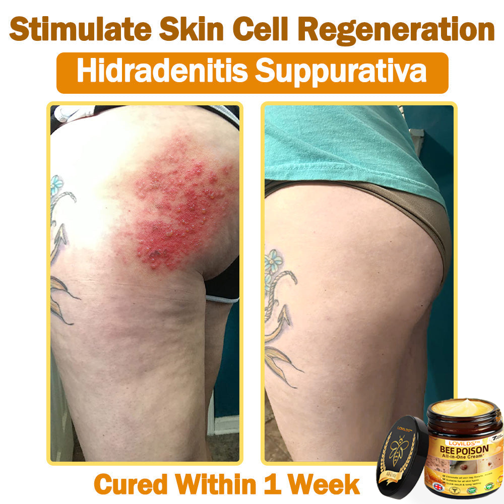 [𝐎𝐟𝐟𝐢𝐜𝐢𝐚𝐥 𝐁𝐫𝐚𝐧𝐝 𝐒𝐭𝐨𝐫𝐞] 🐝 LOVILDS™ 𝐁𝐞𝐞 𝐕𝐞𝐧𝐨𝐦 𝐀𝐥𝐥-𝐢𝐧-𝐎𝐧𝐞 𝐂𝐫𝐞𝐚𝐦 (👩‍⚕️𝐁𝐫𝐢𝐭𝐢𝐬𝐡 𝐀𝐜𝐚𝐝𝐞𝐦𝐲 𝐨𝐟 𝐒𝐜𝐢𝐞𝐧𝐜𝐞 𝐨𝐟 𝐃𝐞𝐫𝐦𝐚𝐭𝐨𝐥𝐨𝐠𝐲 𝟐𝟎𝟐𝟓 𝐒𝐩𝐞𝐜𝐢𝐚𝐥𝐥𝐲 𝐑𝐞𝐜𝐨𝐦𝐦𝐞𝐧𝐝𝐞𝐝 𝐏𝐫𝐨𝐝𝐮𝐜𝐭)💟