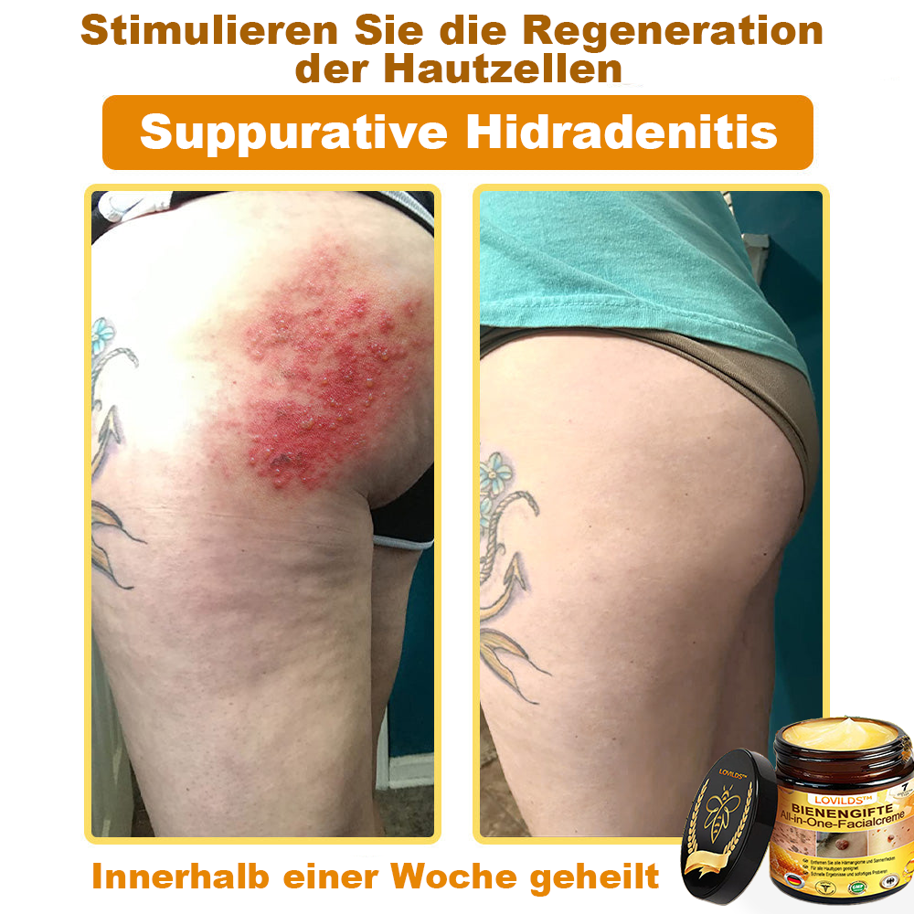 [offizieller Markenshop] 🐝 LOVILDS™ Bienengift-All-Action-Creme (👩‍⚕️ Deutsche Dermatologische Gesellschaft e.V. 𝟐𝟎𝟐𝟓Besonders empfehlenswerte Produkte)💟